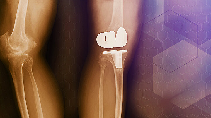 Abstrakcyjna grafika przedstawiająca zdjęcie rtg stawu kolanowego z implantem. W tle struktury chemiczne.